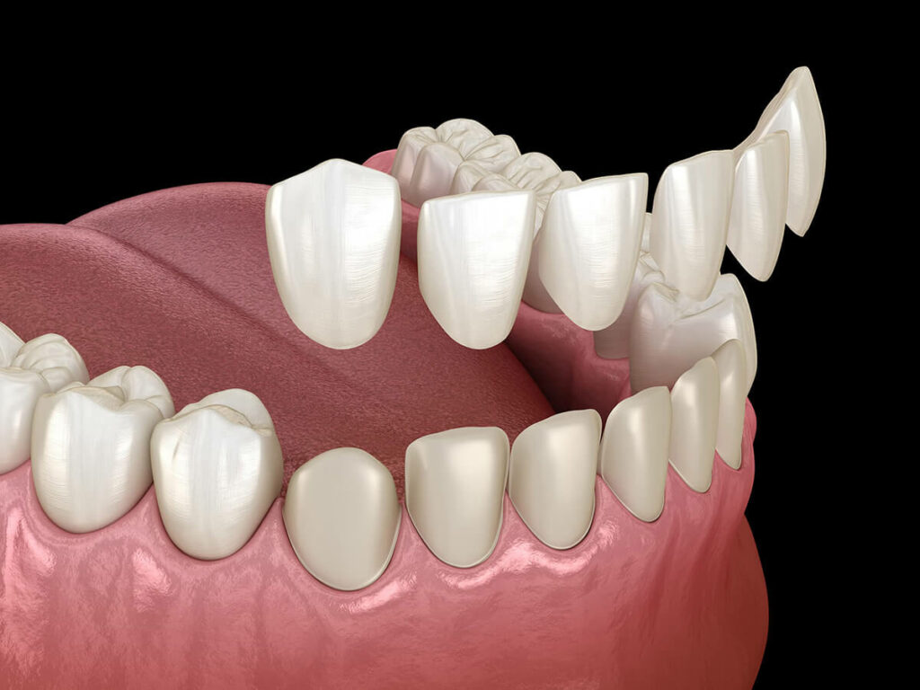 graphic of dental veneers