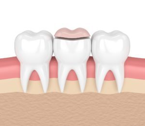 Illustration of a row of three teeth with a dental inlay over the middle tooth