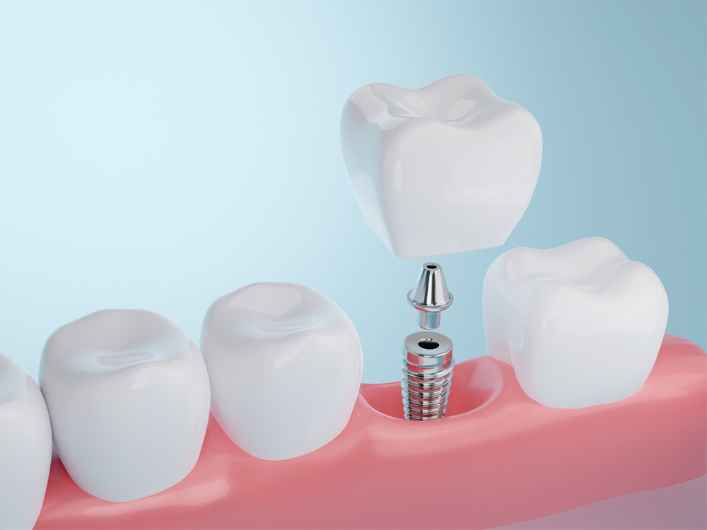 A 3D mockup of the components of a dental implant including post, abutment and crown